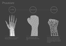 A good look at a long bone. 3d Printed Cast Of Bones A New Way To Heal Arch2o Com