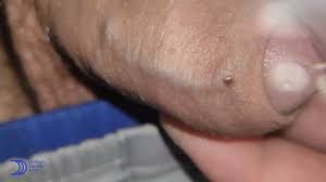 VPH en hombres fotos reales - Urólogo Daniel Carrillo