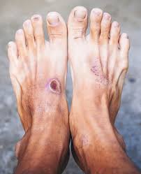 Image result for diabetic toes