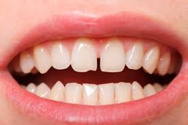 Bacteria can easily build up around the brace brackets so it's important to be extra careful with cleaning your teeth and flossing during this time. Teeth Straightening Don T Do It Yourself University Of Utah Health