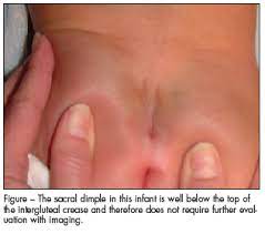 Healthy Infant With Unusual Indentation In His Gluteal Crease Consultant360