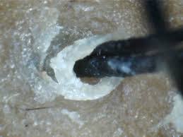 A topical, oral or surgical skin care. What Will Dissolve Sebum Plugs On The Scalp Or Skin Scalp And Skin Blog