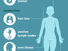Many hair loss physicians and experts believe that androgenic alopecia (male pattern baldness) is generally caused by dht (dihydrotestosterone), as well as this causes the inflammatory process to shed hair and eventually begin shedding as the process continues. Signs Symptoms And Complications Of Syphilis