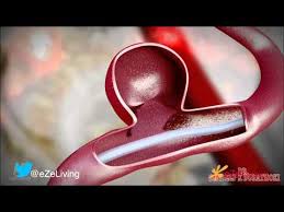 Brain Aneurysm Diagnosis Prevention And Treatment Youtube Abdominal aortic aneurysm, cerebral aneurysm, thoracic aortic aneurysm, peripheral aneurysm.