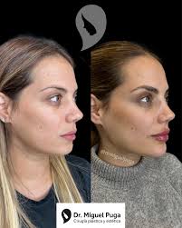 TIR 💉🙌🏻☺️ . 18 meses de diferencia entre la primera y la segunda foto,  una genia mi Paciente 🙏🏻☺️ . Tratamiento Integral del Rostro by Dr. Puga  . Únete a mi canal