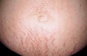 Linea nigra (latin for black line), often referred to as a pregnancy line, is a linear hyperpigmentation that commonly appears on the abdomen. Dermatologic Diseases In Pregnancy Glowm