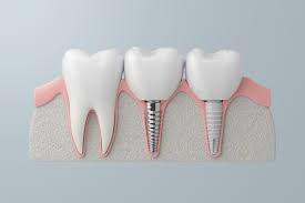 The Science Behind Dental Implants: How Modern Technology Is  Revolutionizing Tooth Replacement
