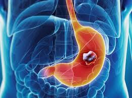 Làm gì để phát hiện sớm ung thư dạ dày giai đoạn đầu?