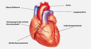 Angina Pectoris Herzenge