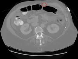 An unusual cause of an acute phase response presenting to the rheumatologist. Malignant Peritoneal Mesothelioma With Refractory Ascites Consultant360