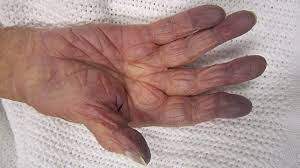 Cold hands and feet are a natural part of how your body regulates its temperature and keeps you alive. Peripheral Cyanosis Symptoms Causes And Treatments