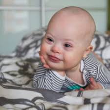 Síndromes de Patau y Edwards: las trisomías más comunes tras el síndrome de  Down