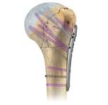 A.L.P.S® Proximal Humerus Plating System