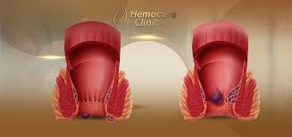 Image result for hemoroid human