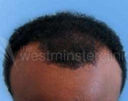 The hair that will be transplanted will be permanent and you will not have to struggle with bald spots anymore. Afro Hair Transplant Westminster Clinic