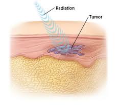 Image result for Intensity-Modulated Radiation Therapy