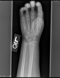 A buckle fracture can often happen in children because their bones are softer than the bones of an older adolescent or adult. Medpix Case Torus Fracture Buckle Fracture Of The Distal Radius