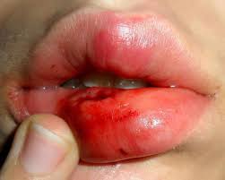 Besonders unangenehm, wenn das kind sich auf die lippe beißt. Nach Fahrradunfall Einen Knoten An Der Unterlippe Unfall Lippe Erbsen