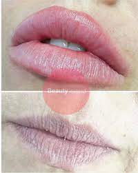Hyaluron Pen Experts Uk Lip Fillers Beauty Courses Perfect Lips