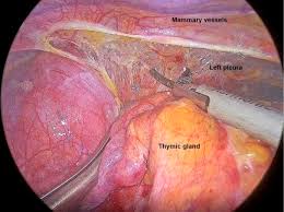 Video Assisted Thoracoscopic Thymectomy Bilateral Approach