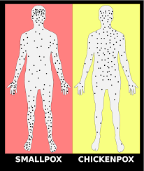 When they were young, we were living in europe, where the medical community does not encourage immunization against this disease. Chickenpox