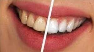 Calcium deposits on teeth can appear as unsightly white spots, and there are several options you can use to try to remove them and improve the appearance of your a dental hygienist can clean calcium deposits from a patient's teeth. How To Get Rid Of Calcium Deposits On Teeth Youtube
