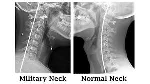 Die besten bücher bei amazon.de. Military Neck Cervical Kyphosis Causes Treatment And More