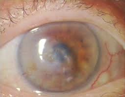 Keratoplastik Munchen Hornhauttransplantation Neuhann Munchen