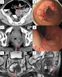 Colon cancer is effected on the large intestine which is the final part of the digestive tract. Synchronous Net And Colorectal Cancer Development A Case Report Surgical Case Reports Full Text