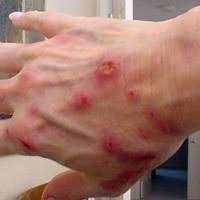 Obat gatal gatal & penyakit kulit paling ampuh 3 hari sembuhvideo ini hanya untuk tujuan pendidikan / umum dan juga berdasarkan pengetahuan dan pengalaman. Morgellons Si Penyakit Kulit Yang Misterius