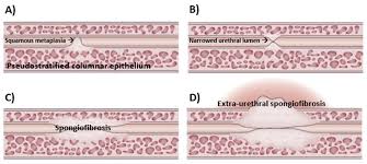 Image result for Urethral Stricture