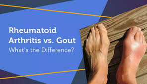 Image result for gout symptoms knee