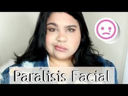 Ejercicios para paralisis facial