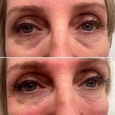 Michelle Deskin Beauty Nurse Injector