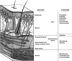Residents and fellows contest rules | international ophthalmologists contest rules. Necrotizing Fasciitis Continuing Education In Anaesthesia Critical Care And Pain