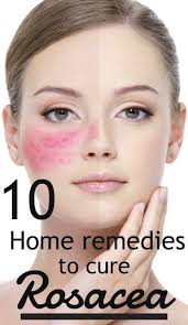 10 Best Home Remedies To Cure Rosacea Top 5 Diy Natural Remedies For Rosacea Rosacea How To Treat Rosacea