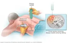 Image result for early treatment for diabetic nephropathy is considered to be what type of prevention