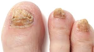 Soaking Feet In Apple Cider Vinegar For Toenail Fungus Does It Work Youtube