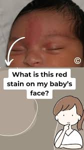 Image result for Nevus Simplex