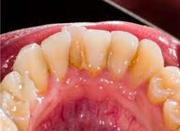 Tartre is patient and attentive to my family's needs and concerns. Tartre Dentaire Definition Symptomes Diagnostic Et Traitement