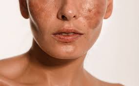Image result for Melasma