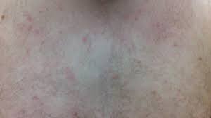 Image result for sweat rash on back