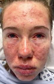 Stevens-Johnson syndrome/toxic epidermal necrolysis: initial assessment