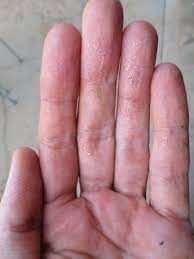 How is dyshidrotic eczema treated? October 2013 The Butterchurn