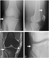 Image result for Segond Fracture