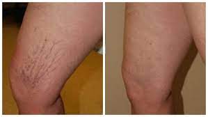 Microsclerotherapy Red Veins Charismetics