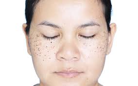 How To Treat And Prevent Scabs On Your Face? – Skinkraft