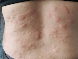 Cara hilangkan gatal badan berpunca gangguan jin & sihir. 7 Cara Mengatasi Biduran Tanpa Obat