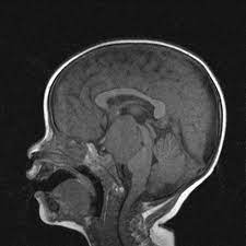Research it at best of the web. Pallister Hall Syndrome Radiology Case Radiopaedia Org