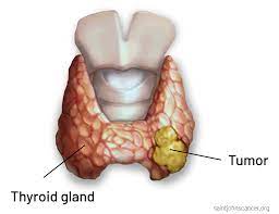 Thyroid Cancer Symptoms, Diagnosis, Surgery, Treatment, and ...